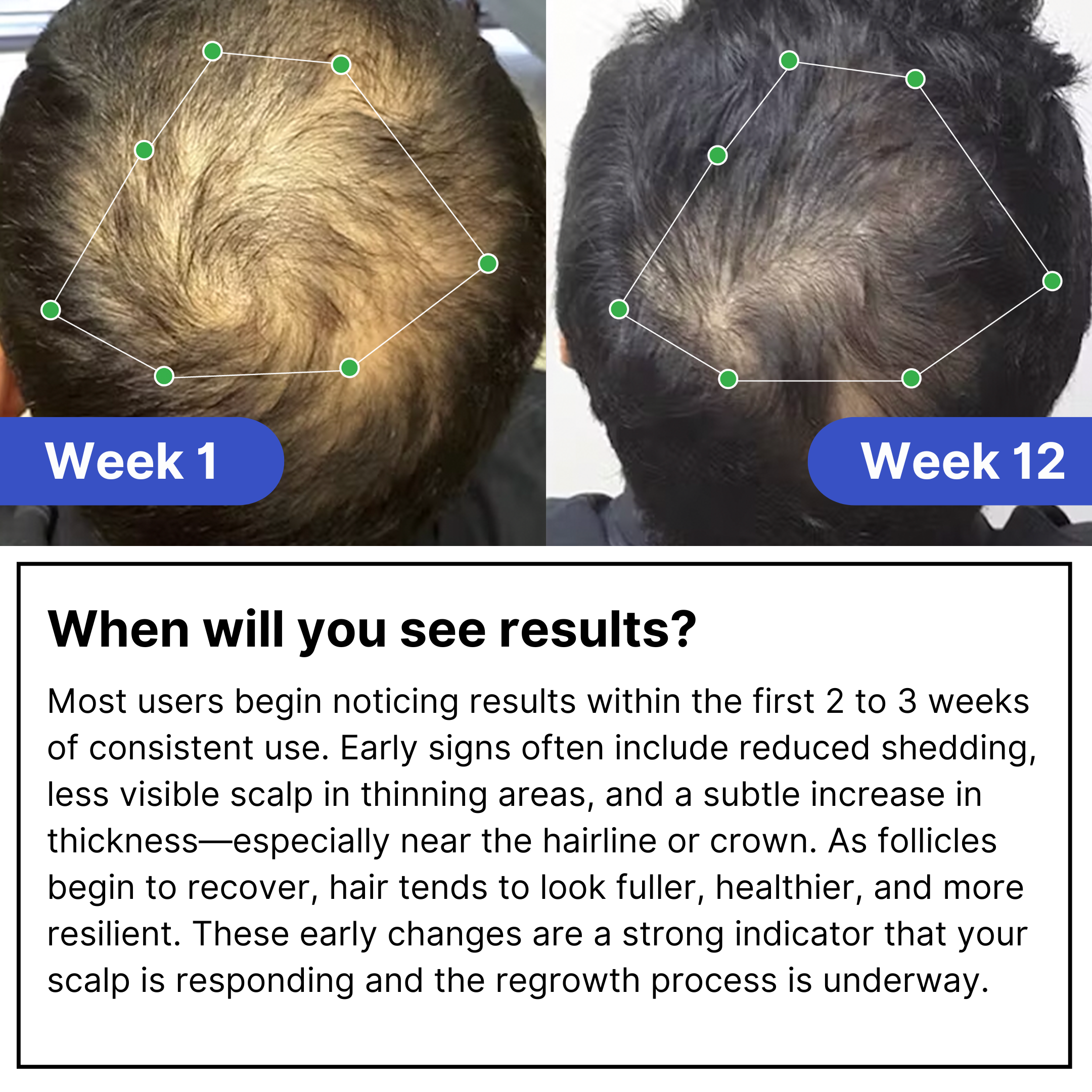 Follix Hair Growth Solution & Precision Applicator Bundle